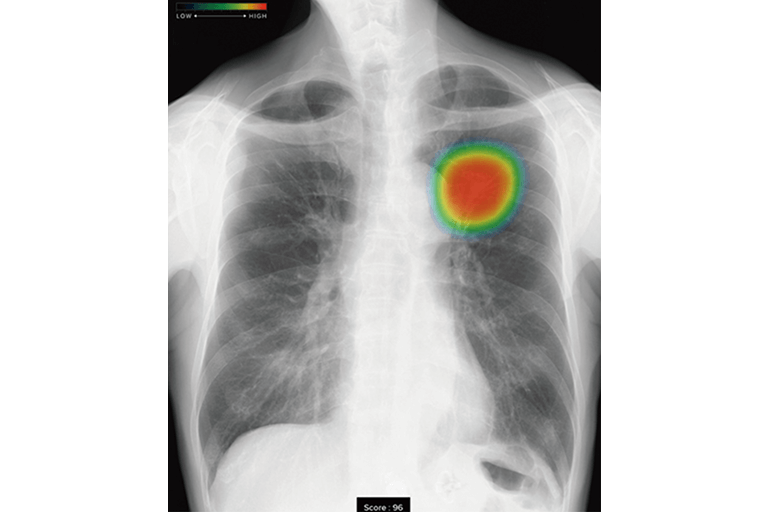 レントゲン、AI読影